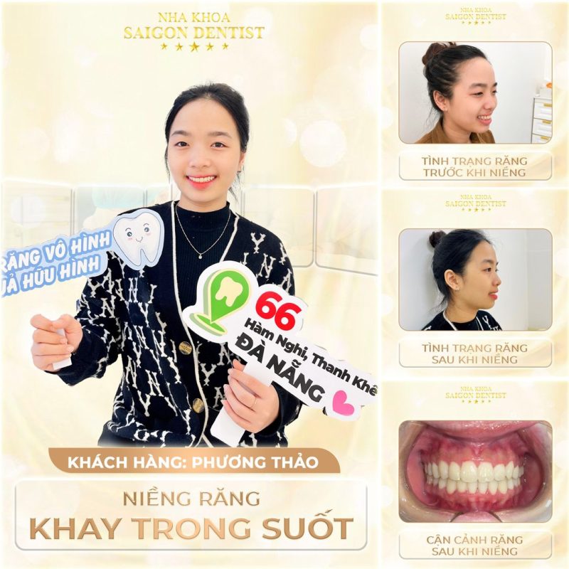 kh-nieng-rang-saigon-dentist